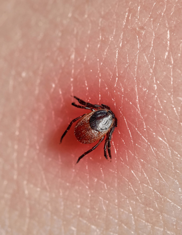 Tick biting down on human skin - Tick Pest Control